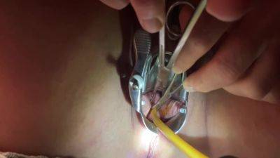 Tenaculum Grasping Cervix For Catheter 7 Min on girlsporntube.one